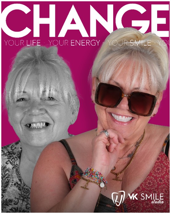 Hollywood smile Turkey