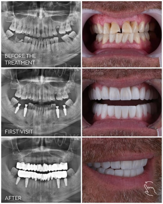 All-on-4 dental implants full arch restoration on four implants