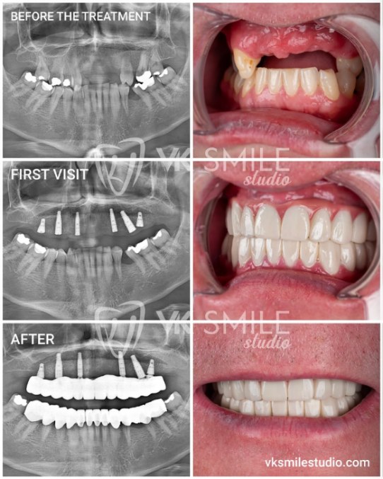 All-on-6 dental implants in Turkey full mouth rehabilitation with six implants