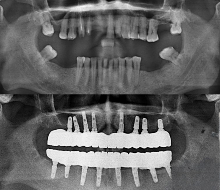 All-on-8-Zahnimplantate