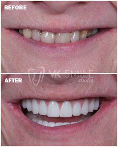 Before After VK Smile Studio (10)