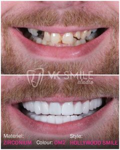 Before After VK Smile Studio (29)