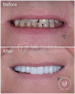 Before After VK Smile Studio (30)