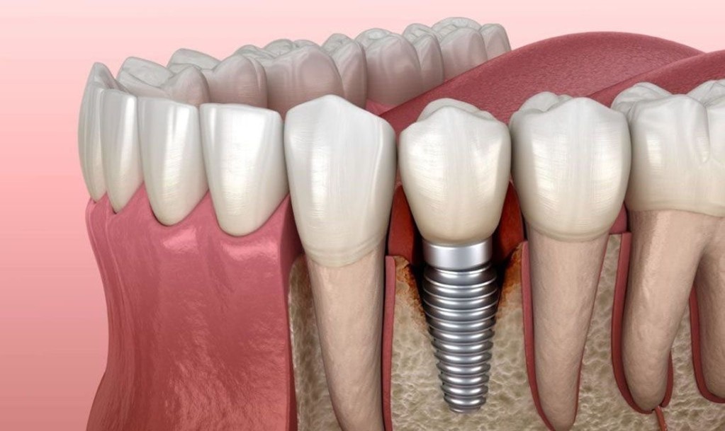 Bone Density For Dental Implants