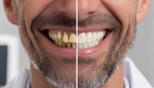 Brown stains on teeth treatment in Turkey