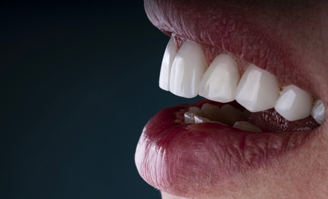 Complete Tooth Repair and Restoration in Turkey