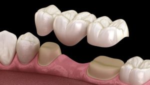 Dental Bridges Treatment in Turkey