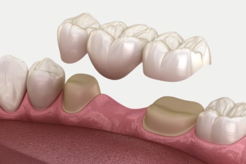 Dental Bridges 