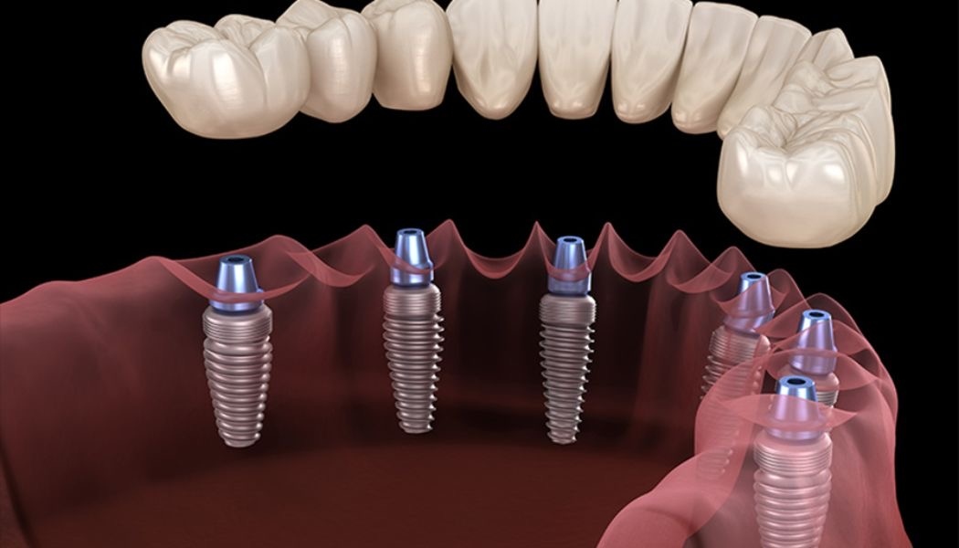 Does Getting Dental Implants in Turkey Hurt?