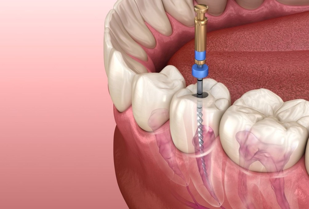 Dental Nerve Removal