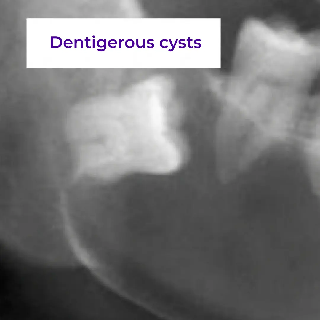 Dentigerous cysts