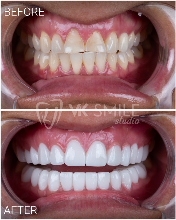 Dental crowns Turkey