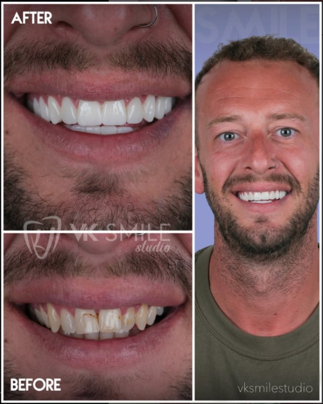 Dental crowns Turkey