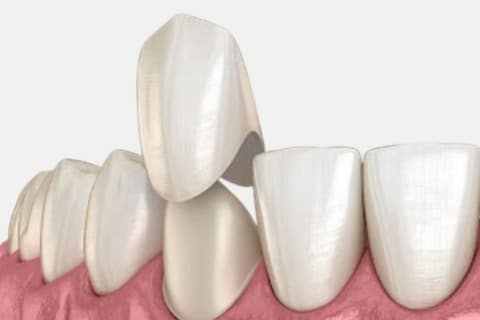 Emax Crowns