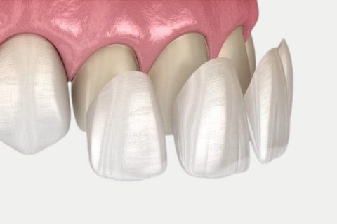 Empress Veneers