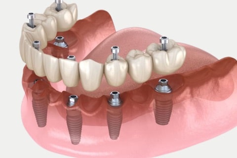 Flapless Dental Implants