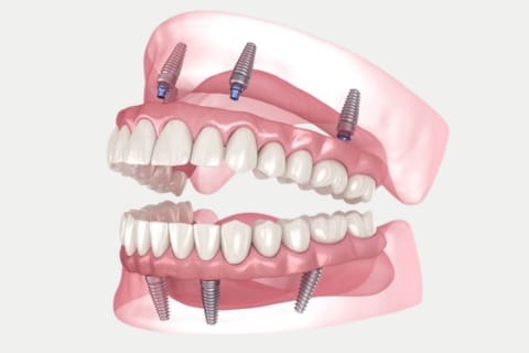 Full Mouth Dental Implants