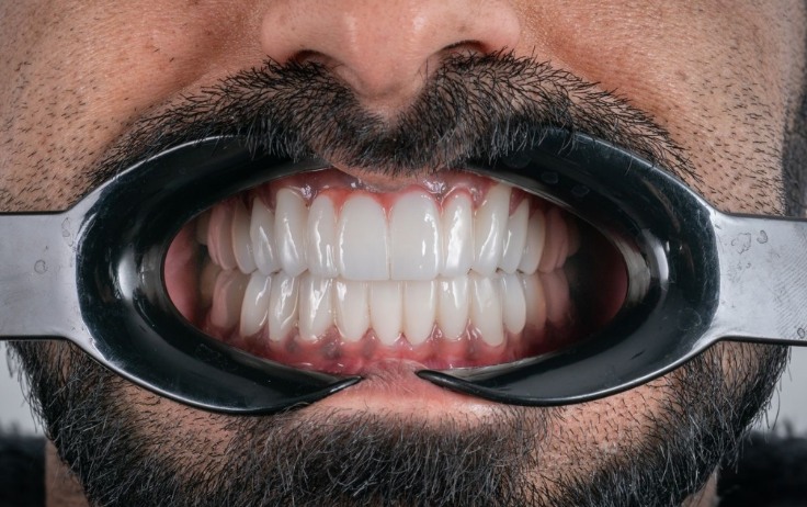 Full Mouth Implants in Turkey