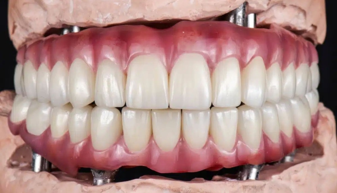 Full mouth dental implants Turkey package deals