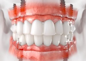 Full mouth dental implants turkey price