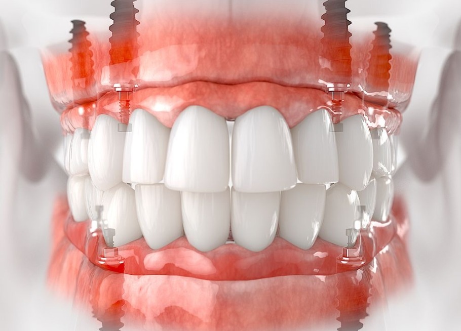 Full mouth dental implants turkey price