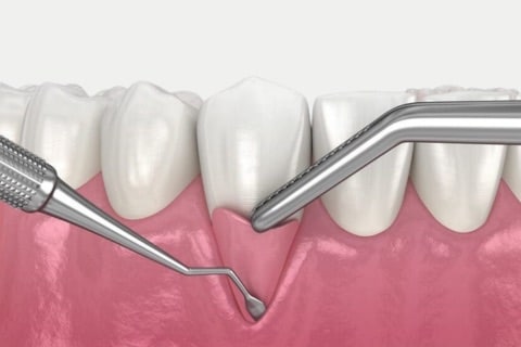 Gum Graft 