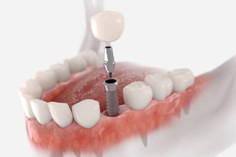 Immediate Dental Implantation