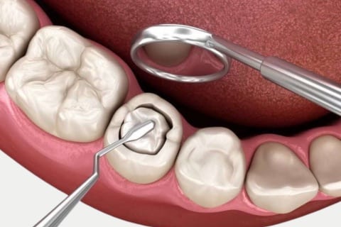 Inlay And Onlay Treatment