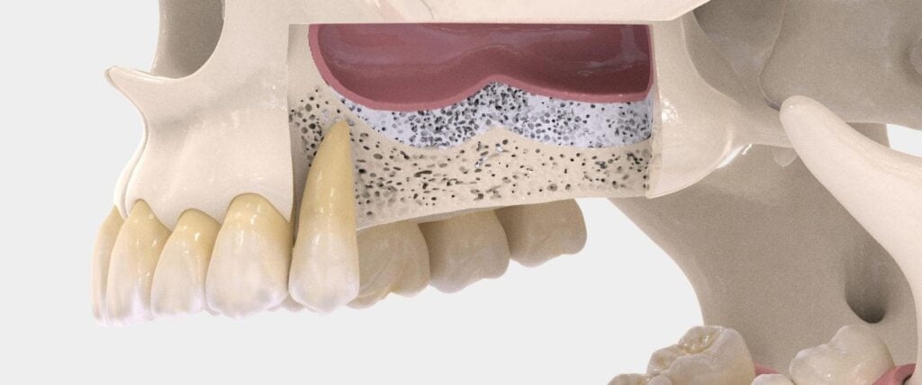 Knochenaufbau Oberkiefer