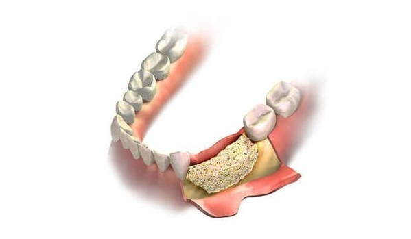 Knochenaufbau Unterkiefer