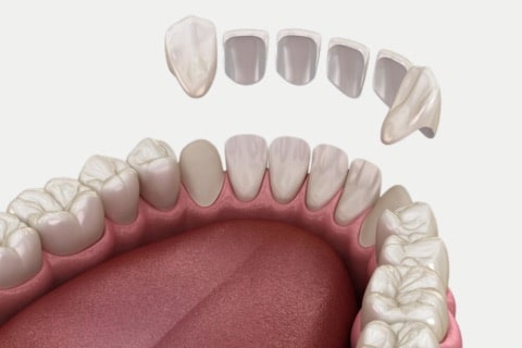 Laminate Veneers