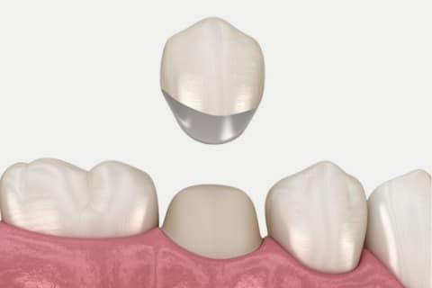Metal Porcelain Crowns