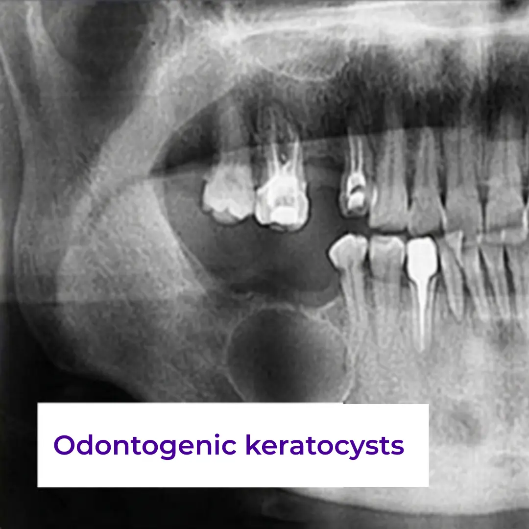 Odontogenic keratocysts