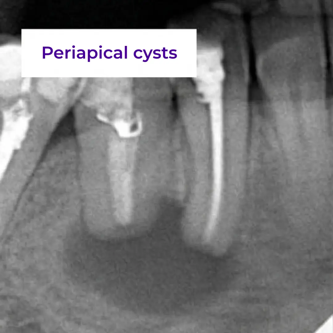 Periapical cysts (Radicular)