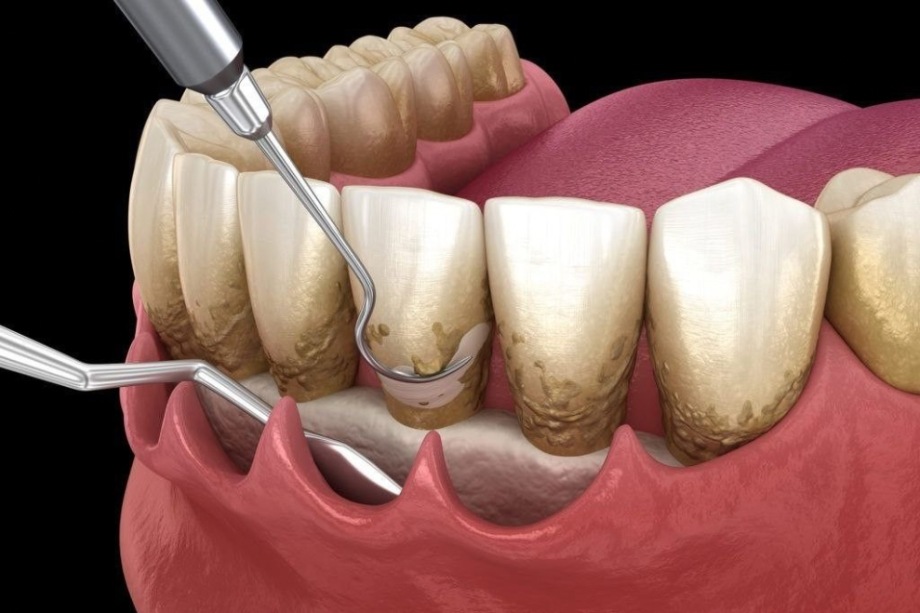 Periodontitis (tooth inflammation)