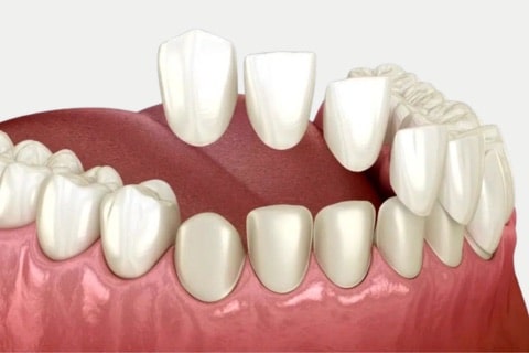 Porcelain Veneers