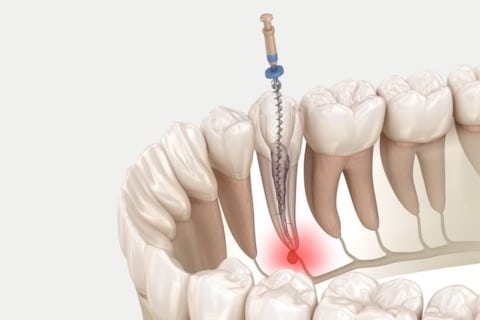 Root Canal Dental Treatment