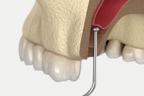 Sinus Lifting