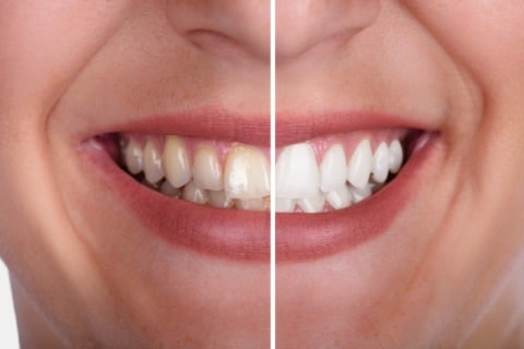 Teeth Whitening