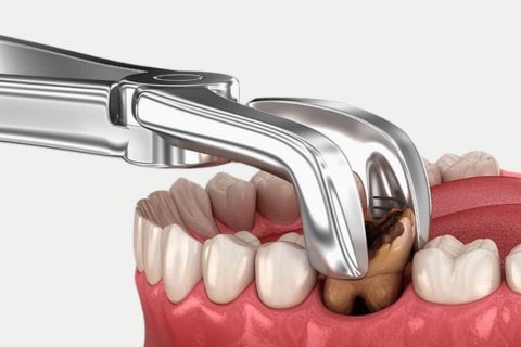 Tooth Extraction