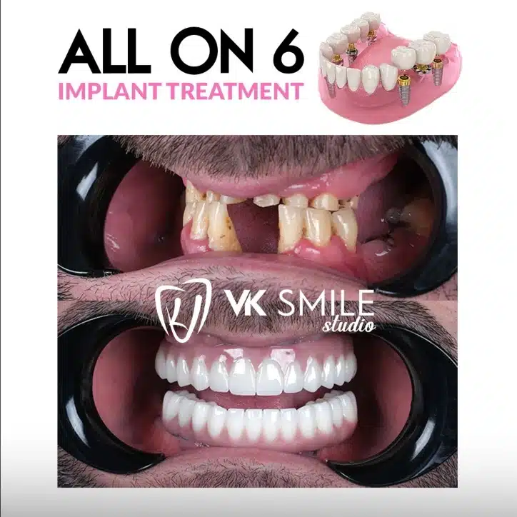 VK Smile Studio before after All on 6