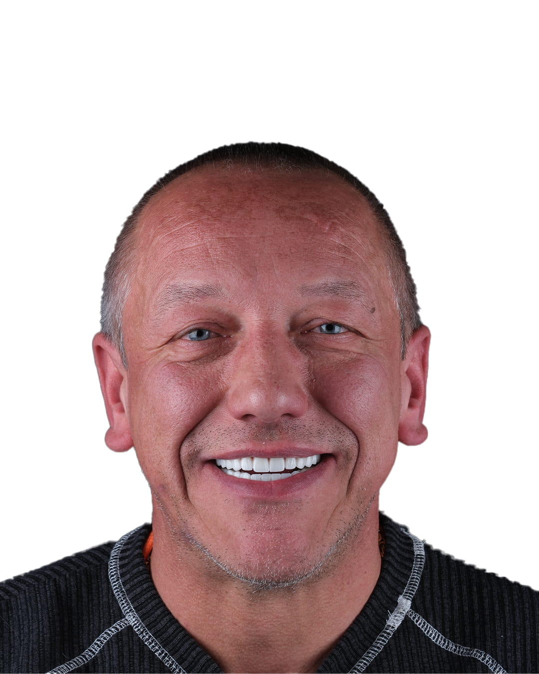 VK Smile Studio before after photo