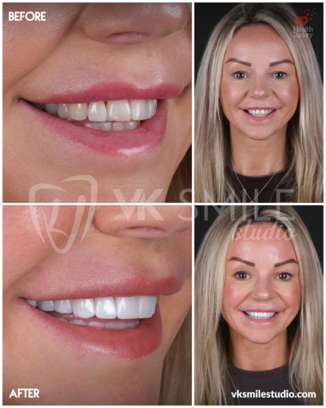 Veneers in der Türkei