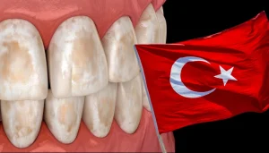 White spots on teeth treatment in Turkey