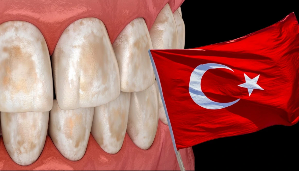 White spots on teeth treatment in Turkey