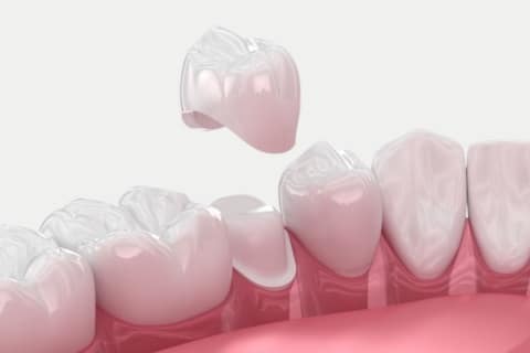 Zirconium Crown