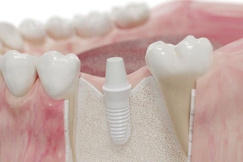 Zirconium Dental Implants