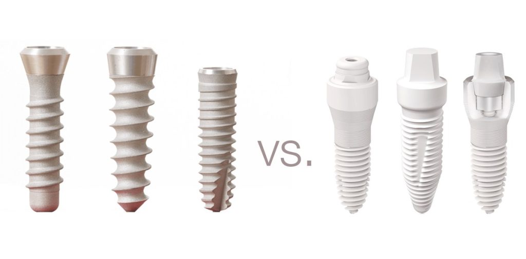 Zirkon vs. Titan Zahnimplantate