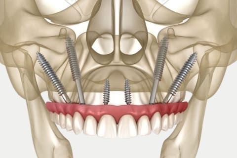 Zygomatic Dental Implant