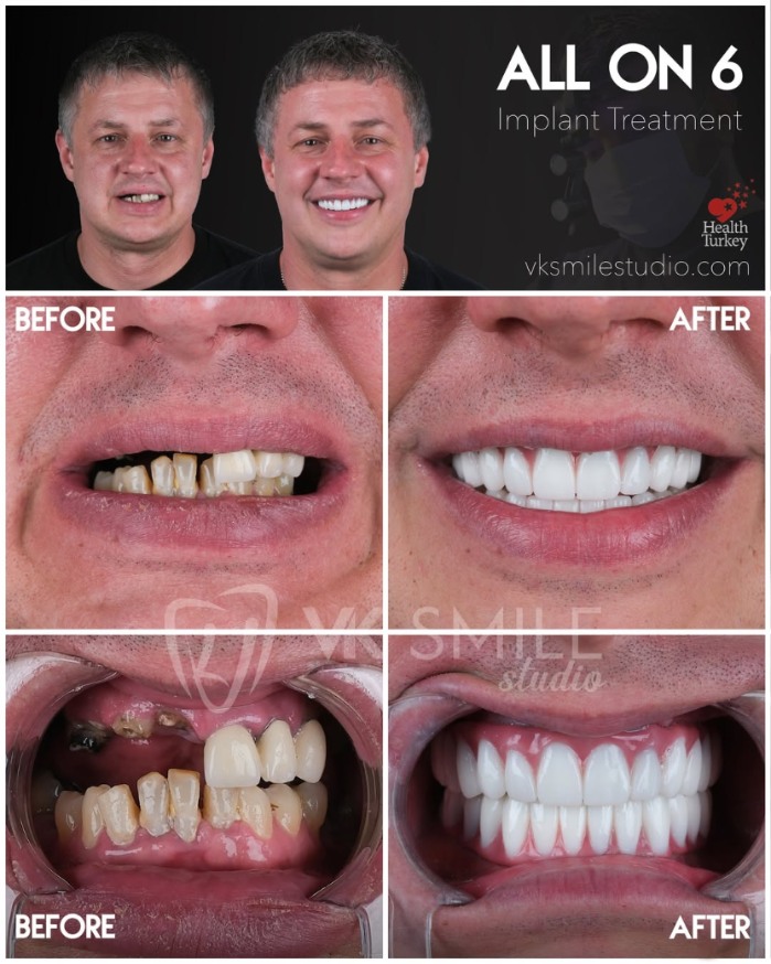 All-on-6 dental implants in Turkey
